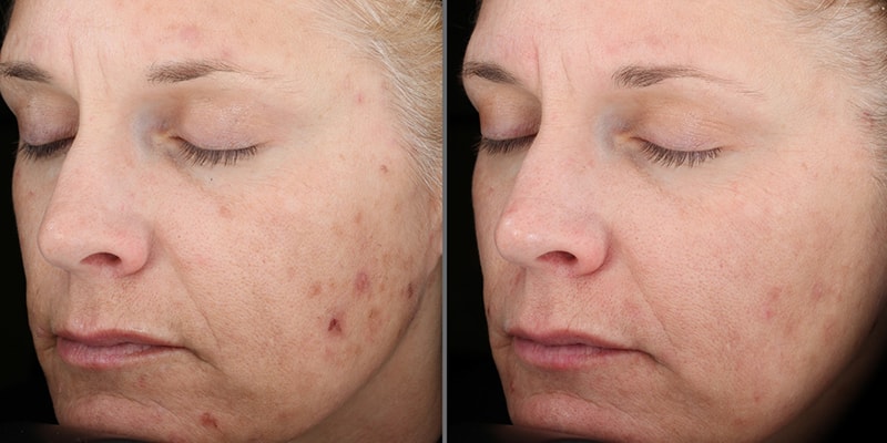 Vitalize Peel Treatment 